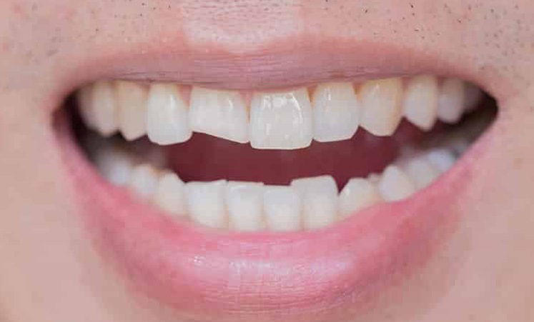 Cracked-Tooth