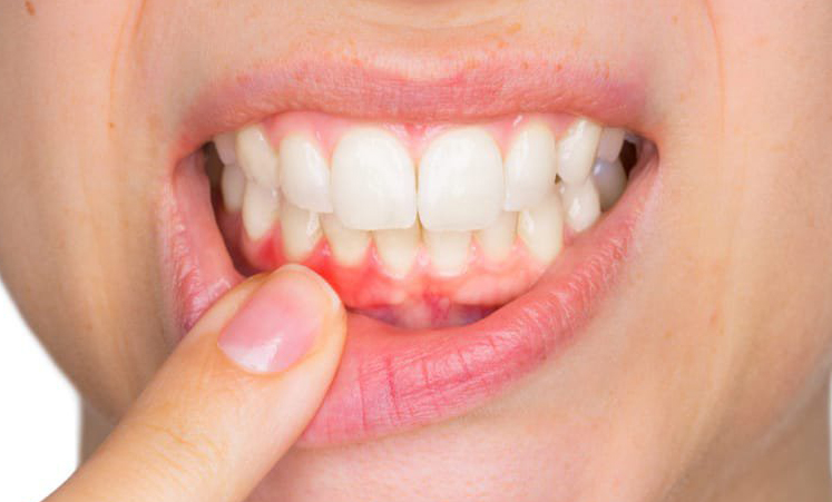 Periodontal-Disease-Treatment