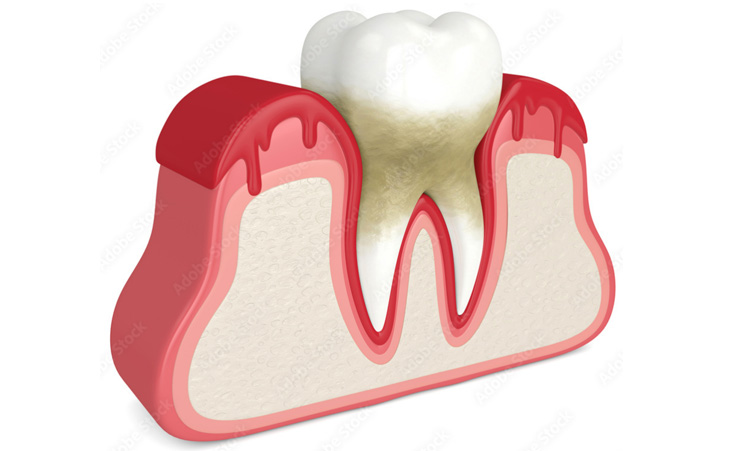 bleding_gums