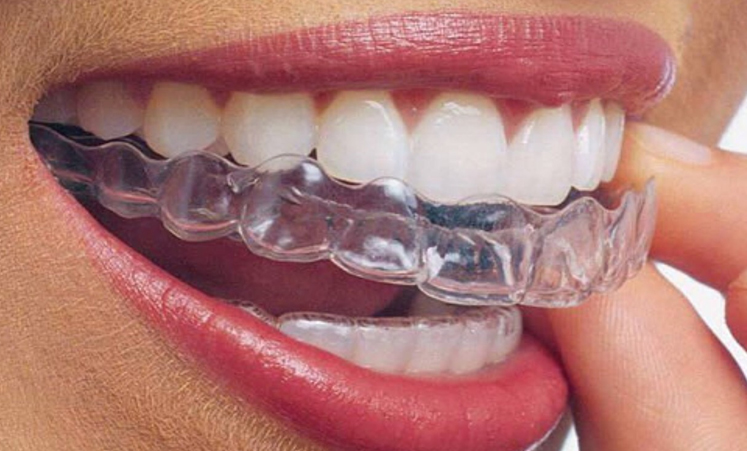 mouthguard