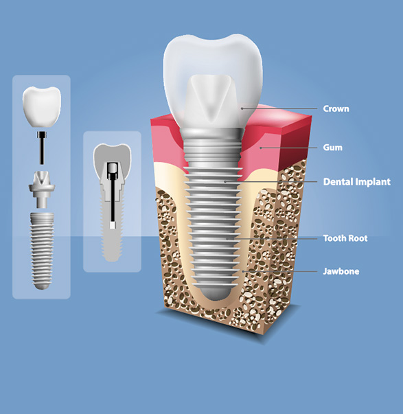 dental-implants