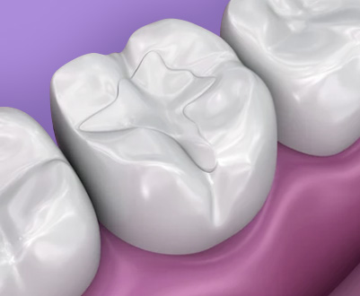 fillings